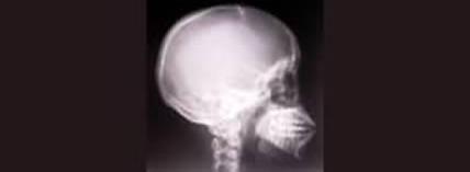 Xray