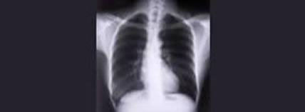 Xray 3